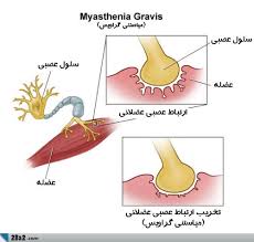 میاستنی گراویس